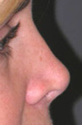 Revision Rhinoplasty - Patient 4 - Lateral Right - Before Revision Rhinoplasty - Patient 4 - Lateral Right - Before